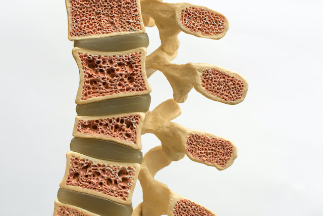 骨粗鬆症認定医による骨粗鬆症治療